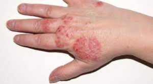 Rash on hand