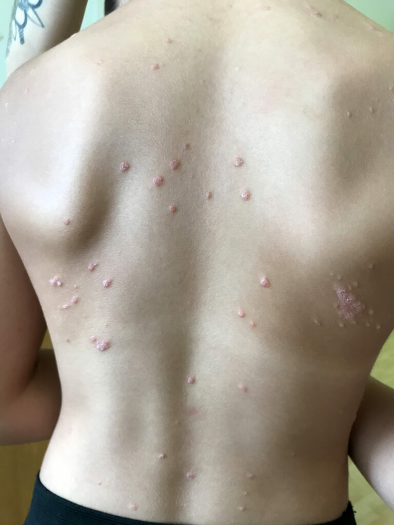 https://upload.wikimedia.org/wikipedia/commons/6/6e/Psoriasis_en_gouttes_enfant_2.jpg